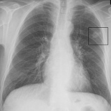 Chest x-ray showing lung cancer in the left lung.