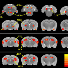 Tinnitus and hyperacusis involve hyperactivity and enhanced connectivity in auditory-limbic- arousal-cerebellar network