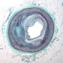 Low magnification micrograph of the distal right coronary artery with complex atherosclerosis and luminal narrowing. Stained with Masson's trichrome.