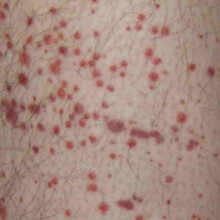 Purpura spots