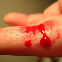 Bleeding finger