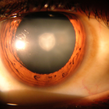 Cataract in Human Eye