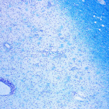 Photomicrograph of a demyelinating MS-Lesion. Klüver-Barerra-Stain. Orgininal Magnification 10x