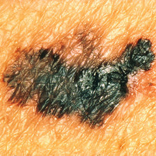 Melanoma