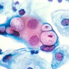 Human cervical pap smear showing clamydia in the vacuoles at 500x and stained with H&E.