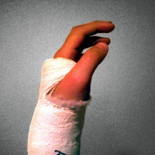 Plaster cast on forearm/wrist/hand. Plaster cast on forearm/wrist/hand