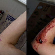 A comparative picture of untreated 7-days-healed road rash in the form of a scar one year later. Fresh wound is on the right, and scar is on the left.