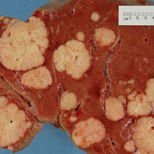 Cross section of a human liver, taken at autopsy examination, showing multiple large pale tumour deposits. The tumour is an adenocarcinoma derived from a primary lesion in the body of the pancreas.