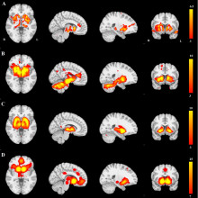 The distribution of brain atrophy in patients with Parkinson's Disease has a network structure.
