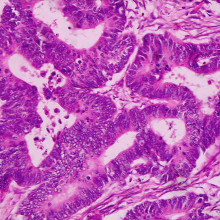 Adenocarcinoma highly differentiated from the rectum (histopathology) taken at Dept. Clinical Pathomorphology and Cytology, Medical University, Lodz, Poland