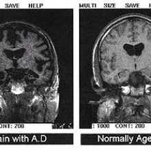 MRI SHOWING AN ALZHEIMERS AFFECTED BRAIN Two transaxial slices through the head. The right image shows a normal brain; the left has differences that are interpreted as indication of Alzheimer's disease