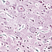 Histopathogic image of senile plaques seen in the cerebral cortex in a patient with Alzheimer disease of pre-senile onset. Silver impregnation.