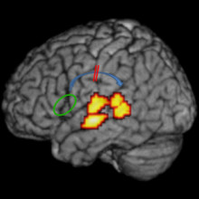 The arcuate fasciculus connecting frontal and temporal language areas of the brain (shown in blue) is impaired in individuals with dyslexia. (Image: Bart Boets, Leuven University).