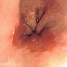 Endoscopic image of Barrett's esophagus