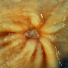 Gastric Ulcer Benign Gastric Ulcer