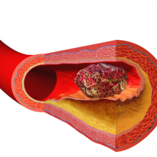 Blocked artery