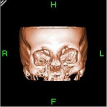 Bone reconstructed in 3D