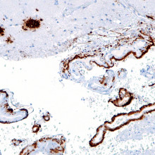Intermediate magnification micrograph of cerebral amyloid angiopathy with senile plaques in the cerebral cortex consistent of amyloid beta, as may be seen in Alzheimer disease. Amyloid beta immunostain.