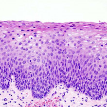 Cervical Intraepithelial Neoplasia CIN2