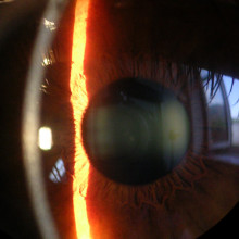 Slit lamp image of cornea, iris and lens.