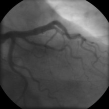 The coronary angiogram (LCA) of a man.