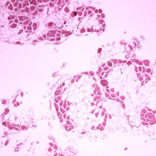 Histopathology of gastrocnemius muscle from patient who died of pseudohypertrophic muscular dystrophy, Duchenne type. Cross section of muscle shows extensive replacement of muscle fibers by adipose cells.
