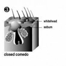 closed comedone - sebum build-up