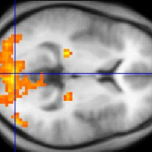  This example of fMRI data shows regions of activation including primary visual cortex (V1, BA17), extrastriate visual cortex and lateral geniculate body in a comparison between a task involving a complex moving visual stimulus and rest condition...