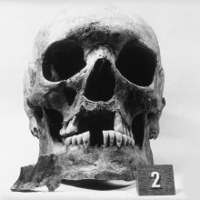 Skull showing loss of front teeth, widening of the nose opening, and loss of bone in upper jaw underneath nose - Excavated from the 12th-16th century AD leprosy hospital cemetery at Naestved, Denmark