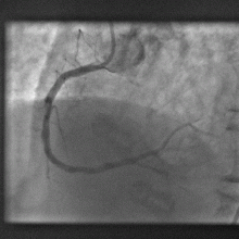 Figure 3: The right heart artery has been opened and the stent has been positioned below the catheter tube.