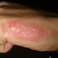 2nd degree burns on hand