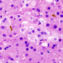 Histopatholgical image of hepatocellular carcinoma in a patient with liver cirrhosis by chronic hepatitis C infection. Hematoxylin and eosin stain.