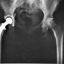 Total hip replacement, x-ray