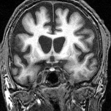 Coronal image of the human brain at the level of the caudate nuclei demonstrating marked reduced volume in keeping with the patient's known diagnosis of Huntington disease.