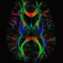 Diffusion Tensor Imaging (DTI) image Diffusion Tensor Imaging (DTI) image
