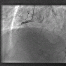 Figure 2: Again catheter tube from leg can be seen in top centre of picture and below that the blocked right heart artery.