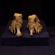 Bones from the feet of a leper, clearly deformed by the illness. Museum Ribes Vikinger, Ribe, Denmark, May 2005