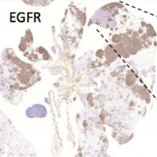  Lung cancer in mice with expression of two different cancer causing mutations. When we actually took the tumours out of these mice later on, and actually looked to see if both these genes were expressed, we found that only one of the two was...
