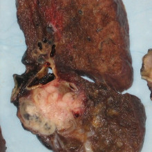 A lung carcinoma; the cancerous lesion appears as the white mass at the lung hilum.