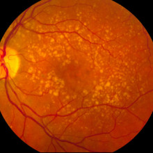 A fundus photo showing intermediate age-related macular degeneration.