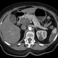 Axial CT image with i.v. contrast. Macrocystic adenocarcinoma of the pancreatic head.