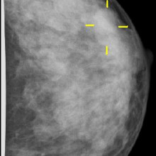 Mammogram showing breast cancer