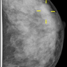 Breast cancer on mammogram Mammogram showing breast cancer