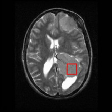 MRI brain scan used as MRS localiser