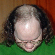 Male Pattern Baldness