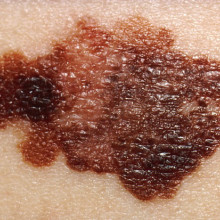 Photograph showing the appearance of melanoma, a pigmented skin cancer.