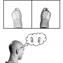  A diagrammatic explanation of the mirror box. The patient places the good limb into one side of the box (in this case the right hand) and the amputated limb into the other side. Due to the mirror, the patient sees a reflection of his good hand where...
