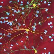 Single striatal neurons (yellow) transfected with nuclear inclusion (orange) mHtt, other neurons in background (blue).