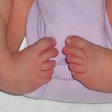 Bilateral club foot Bilateral club foot