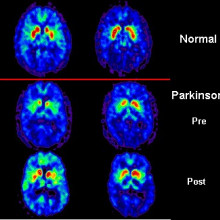 PET scan of Parkinson's patient